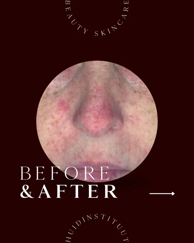 ROSACEA BEFORE & AFTER🙏🏼

Bereik een gezonde, veerkrachtige en egale huid op celniveau.🧬

Rosacea is een uitdagende huidaandoening die gepaard gaat met roodheid, zichtbare bloedvaatjes, ontstekingen en soms ook verdikking van de huid. Bepaalde triggers zoals temperatuurwisselingen, pittig eten, alcohol en stress kunnen de symptomen verergeren.

Er is geen ‘one size fits all’ oplossing. Een effectieve aanpak vraagt om maatwerk; een combinatie van: medische huidproducten, hoogwaardige voedingssupplementen, professionele behandelingen zoals IPL lasertherapie, en soms ook aanpassingen in levensstijl.

Gun jezelf een oplossing die wél werkt!✨

🔗 Afspraak maken? Plan makkelijk en snel online via link in bio
 📱 06 13 81 80 59
✉️ info@beautyskincare.nl
🌐 www.beautyskincare.nl
📍 Alteveerstraat 11, Hoogeveen

#couperose #rosacea #roodheid #huidverbetering #mooiehuid #gezondehuid